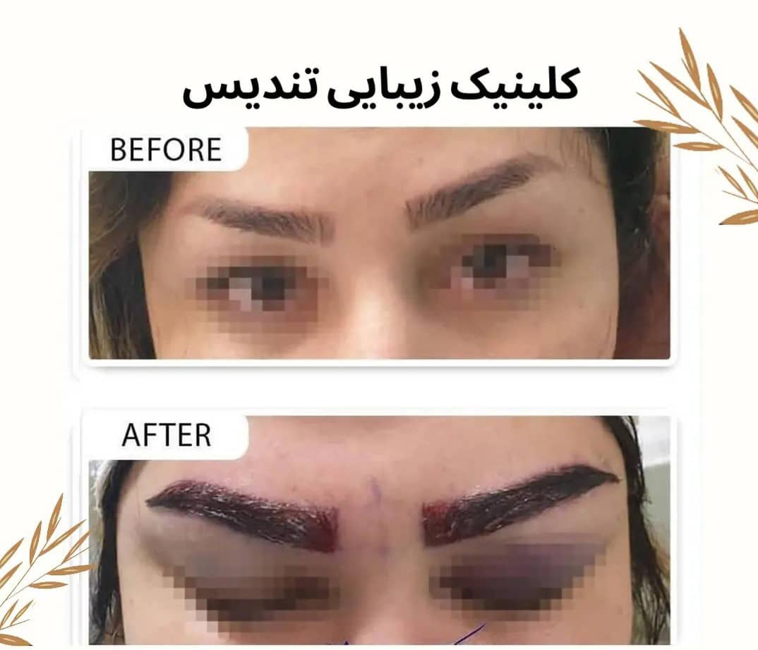 کلینیک فوق تخصصی کاشت مو و زیبایی تندیس سلامت در مشهد